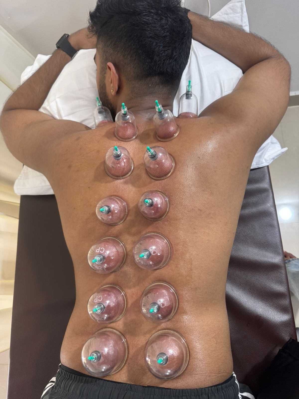 Dry Cupping