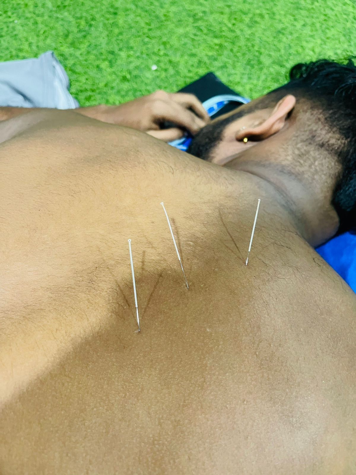Precision Needling